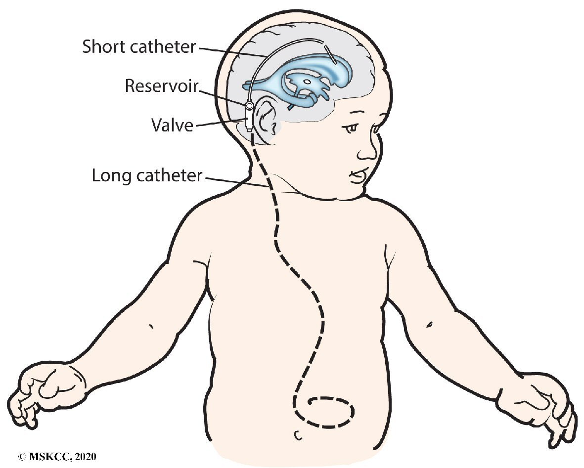 Trend Of Death In Pediatric Ventriculo Peritoneal Shunts In The United 